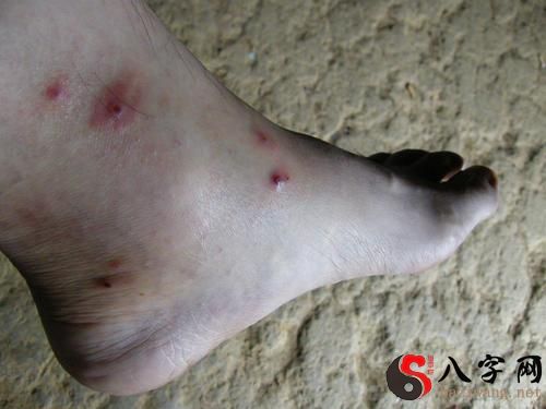 梦见自己身上有虱子