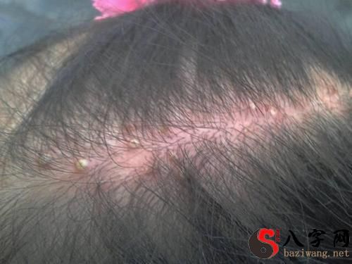 梦见头上有臭虫