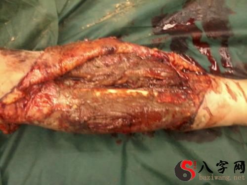 梦见自己小腿受伤流血